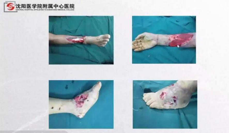 聚焦顯微外科|葫蘆島市醫(yī)學(xué)會(huì)顯微外科學(xué)分會(huì)第一屆第二次學(xué)術(shù)會(huì)議順利召開(kāi)(圖8) 聚焦顯微外科|葫蘆島市醫(yī)學(xué)會(huì)顯微外科學(xué)分會(huì)第一屆第二次學(xué)術(shù)會(huì)議順利召開(kāi)(圖8)