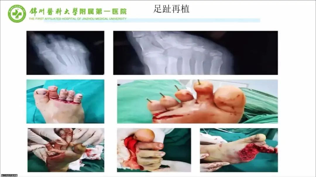 聚焦顯微外科|葫蘆島市醫(yī)學(xué)會(huì)顯微外科學(xué)分會(huì)第一屆第二次學(xué)術(shù)會(huì)議順利召開(kāi)(圖16) 聚焦顯微外科|葫蘆島市醫(yī)學(xué)會(huì)顯微外科學(xué)分會(huì)第一屆第二次學(xué)術(shù)會(huì)議順利召開(kāi)(圖16)